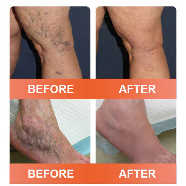 🎉🌟Zvoevo® Vein Ease Microneedle Care Patch(For Spider Veins, Varicose Veins, Swelling & Leg Fatigue)