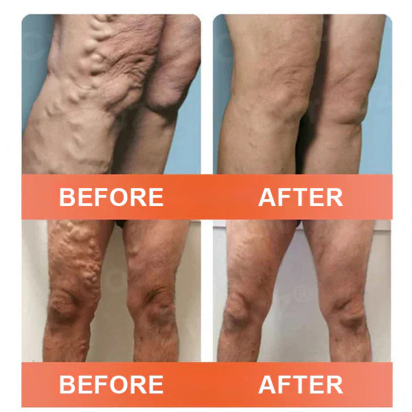 🎉🌟Zvoevo® Vein Ease Microneedle Care Patch(For Spider Veins, Varicose Veins, Swelling & Leg Fatigue)