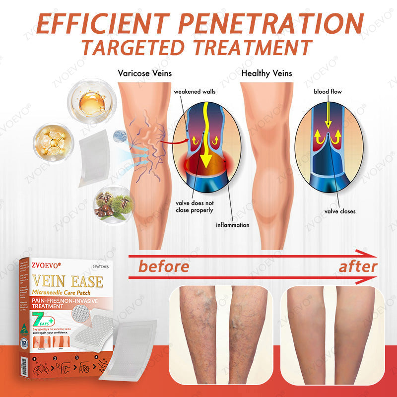 🎉🌟Zvoevo® Vein Ease Microneedle Care Patch(For Spider Veins, Varicose Veins, Swelling & Leg Fatigue)