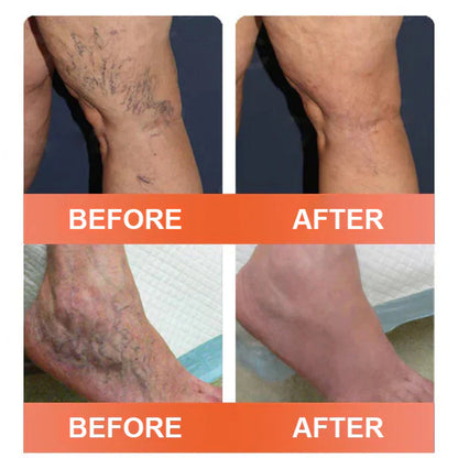 🎉🌟Zvoevo® Vein Ease Microneedle Care Patch(For Spider Veins, Varicose Veins, Swelling & Leg Fatigue)