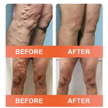 🎉🌟Zvoevo® Vein Ease Microneedle Care Patch(For Spider Veins, Varicose Veins, Swelling & Leg Fatigue)