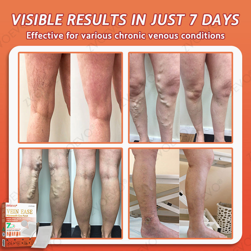 🎉🌟Zvoevo® Vein Ease Microneedle Care Patch(For Spider Veins, Varicose Veins, Swelling & Leg Fatigue)